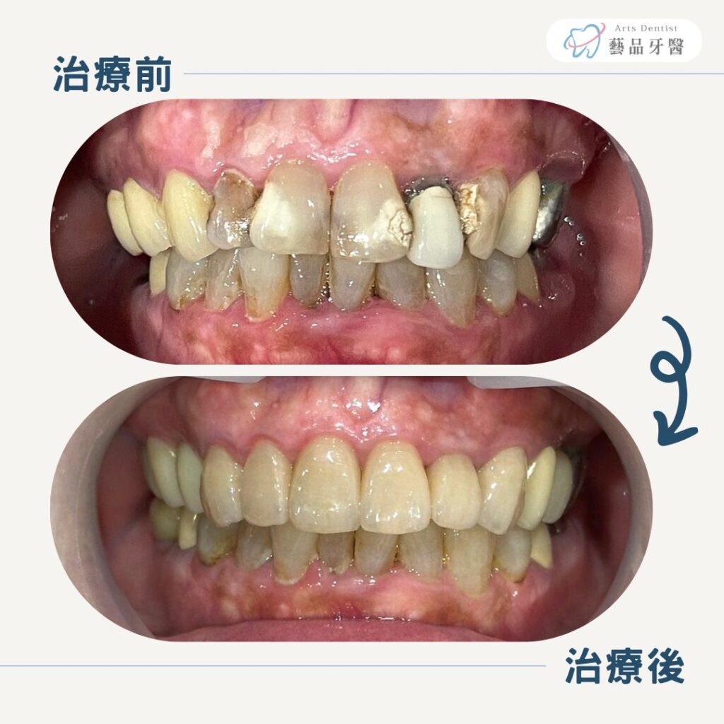 前牙美學案例7