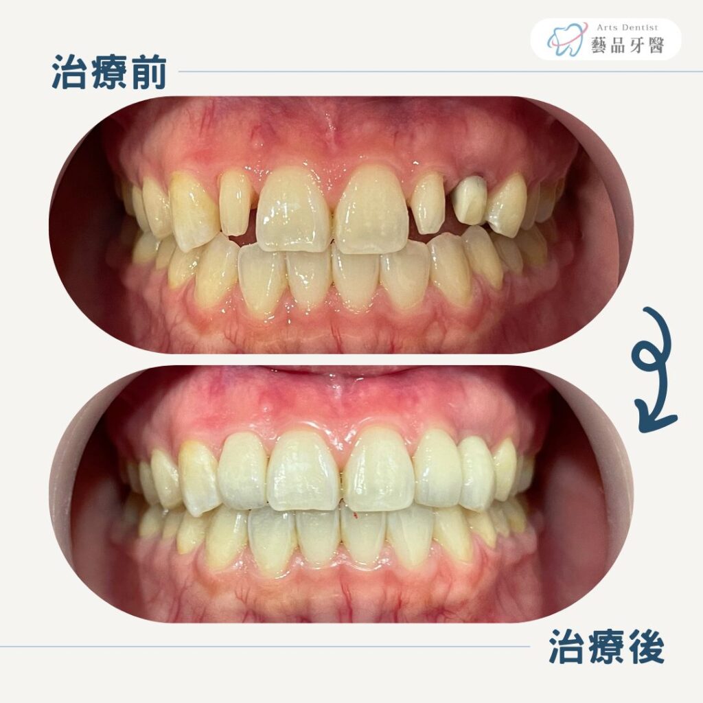 anterior esthetic case 8