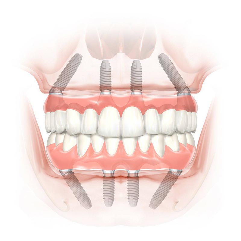 淺談全口重建：解決多顆缺牙或無牙的治療方案
