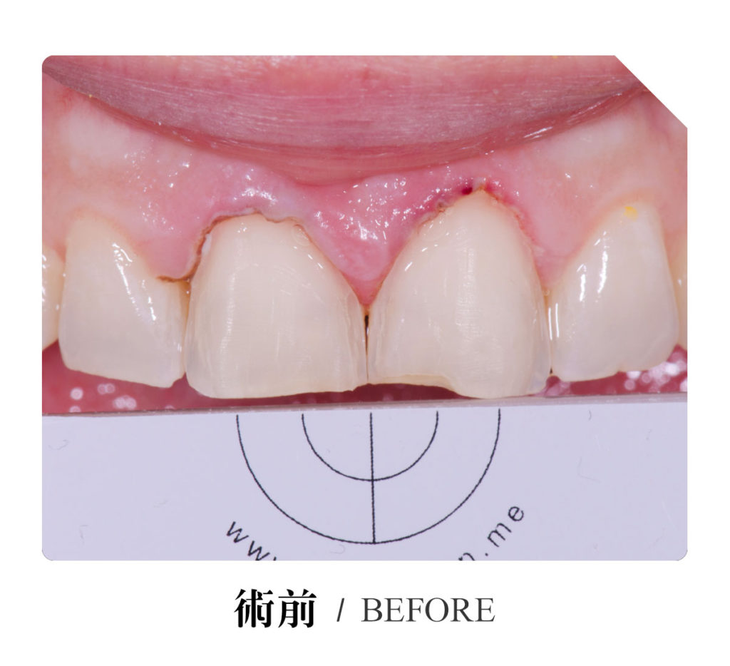 假牙 Rosmary 術前1