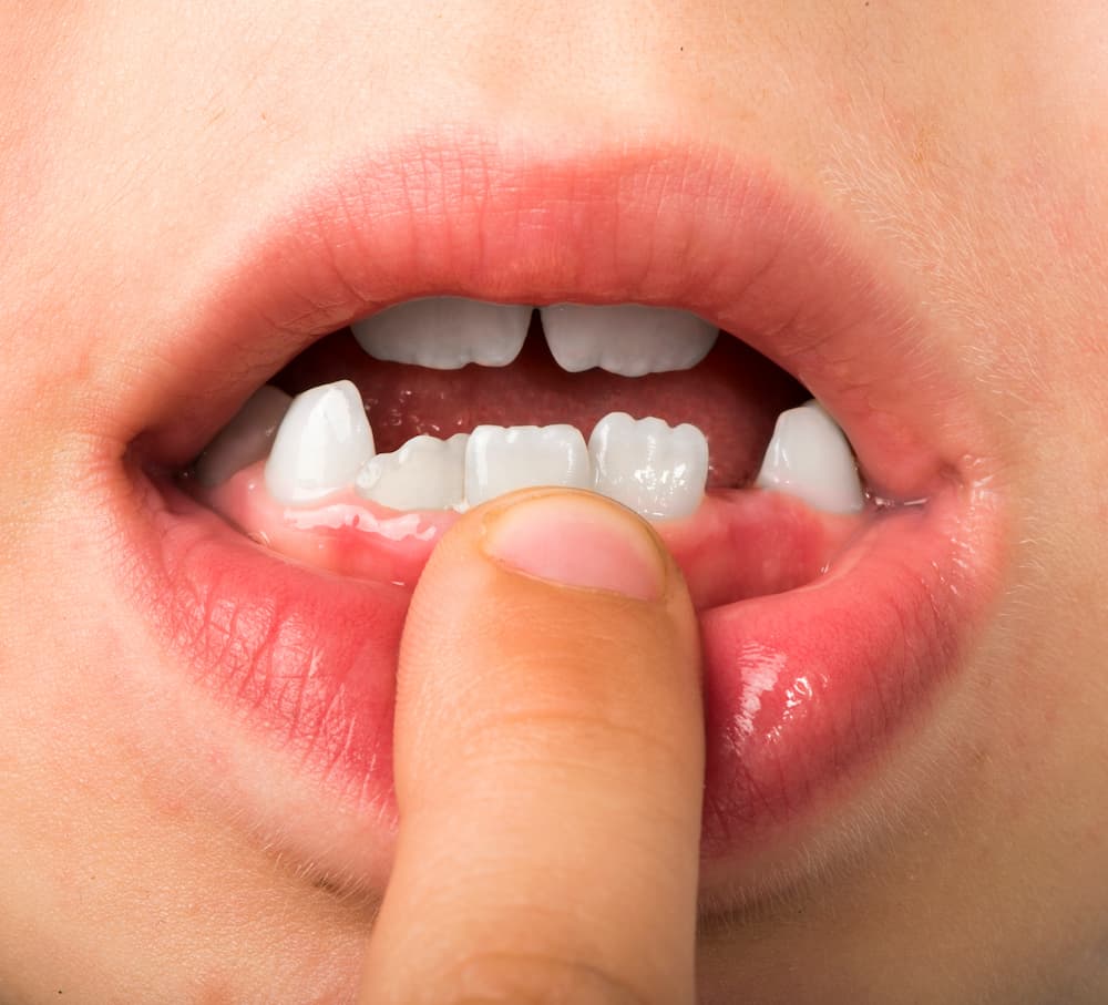 缺牙矯正就能免植牙嗎？缺牙矯正推薦醫師告訴你
