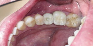 植牙假牙案例 small 2