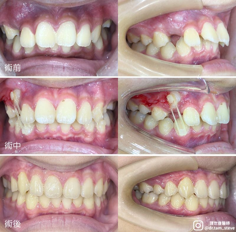 CASE1開側窗 1 1 1