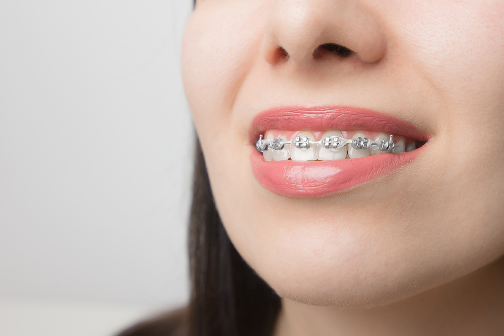 young woman smile with dental braces brackets on 2021 10 12 23 20 05 utc