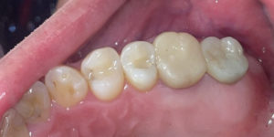 implant case5 small