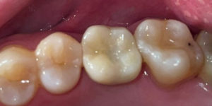 implant case6 small