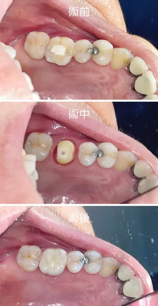 全瓷冠案例後牙 041801 1 1