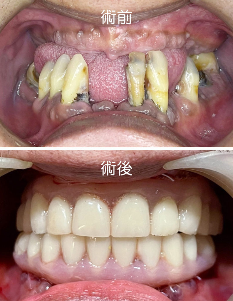 implant allon4 case 0513 1