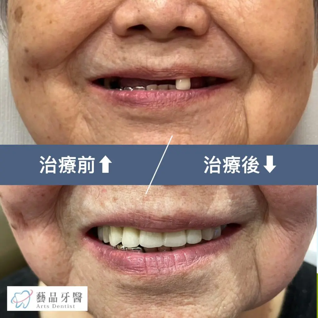 全口重建 4 artsdental case