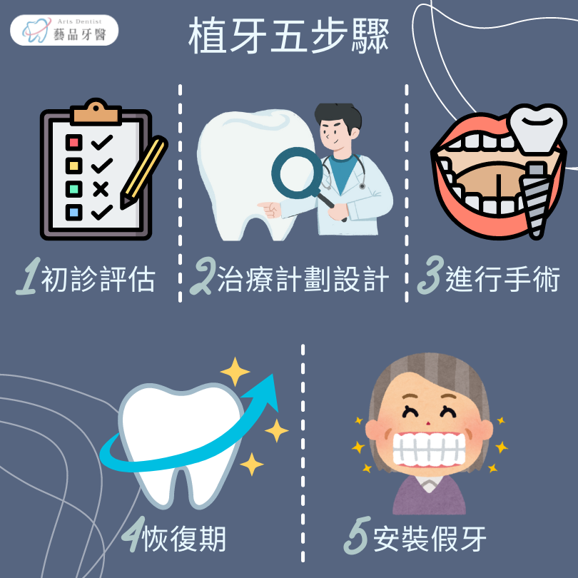 全口植牙要多少錢?ptt鄉民都在討論的全口植牙價格 2 全口植牙流程
