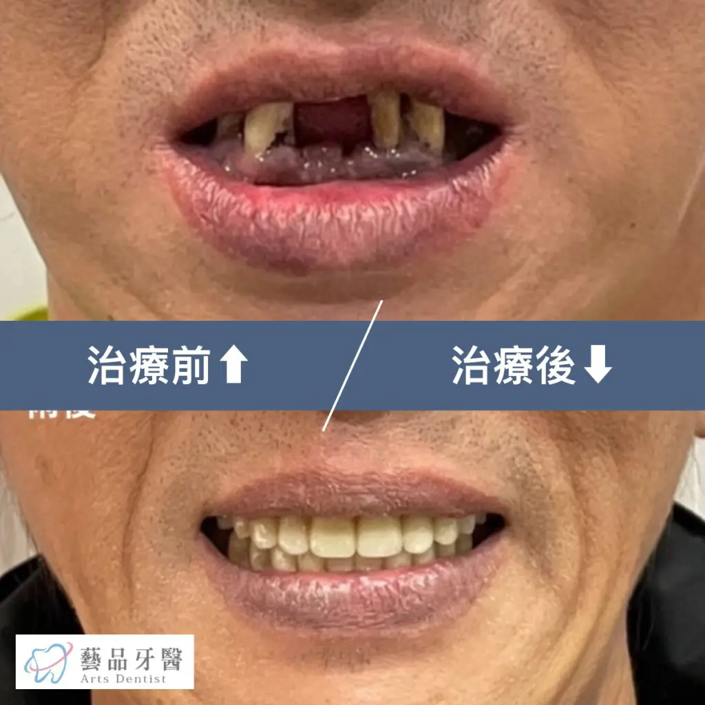 全口重建 2 一日植牙案例