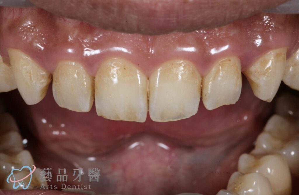 美齒陶瓷貼片 1 藝品貼片左