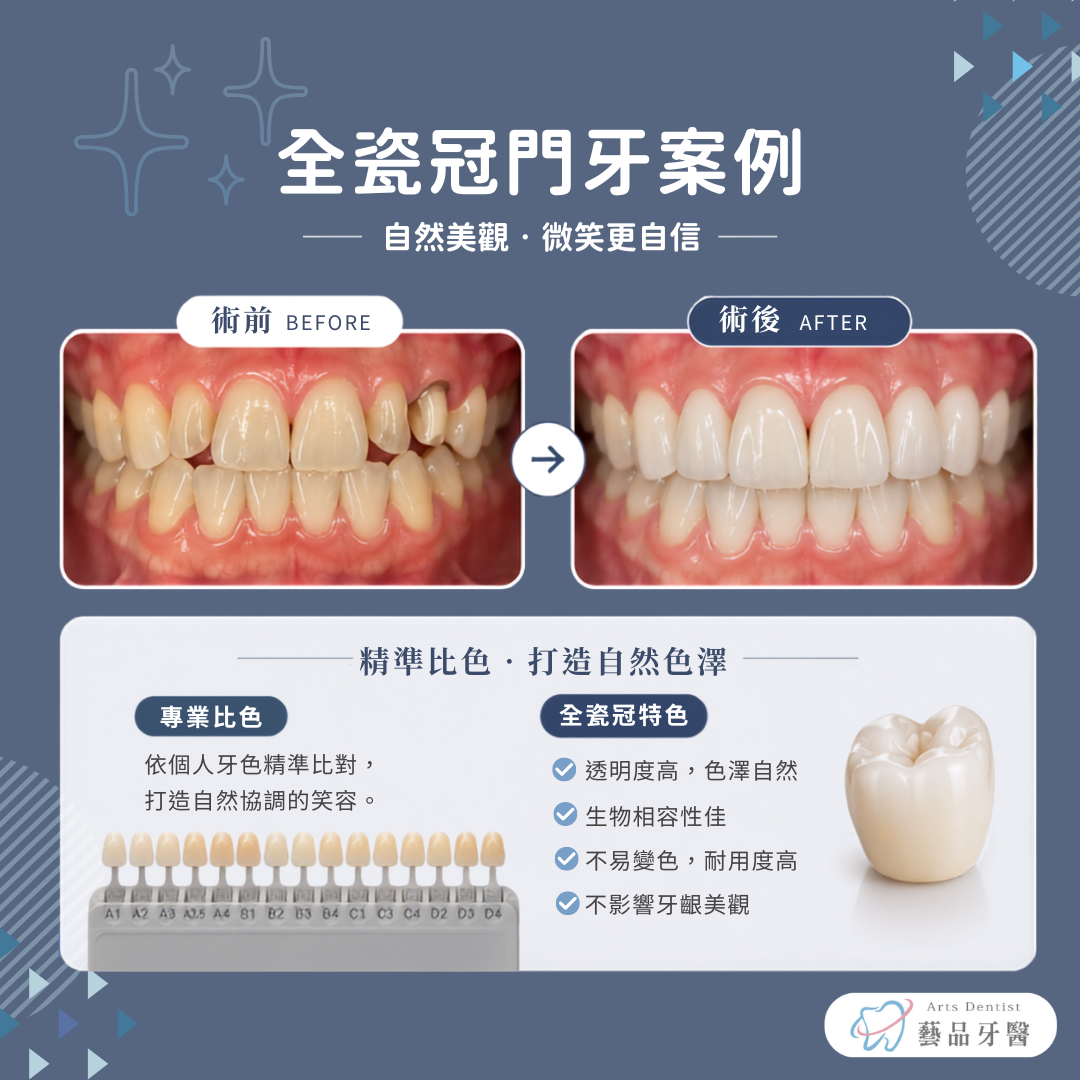 全瓷冠門牙術前術後案例與自然比色設計