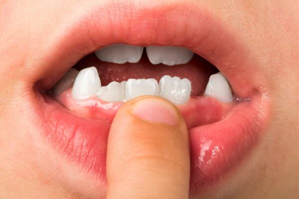 child-shows-missing-teeth-RDBVWLK (1)