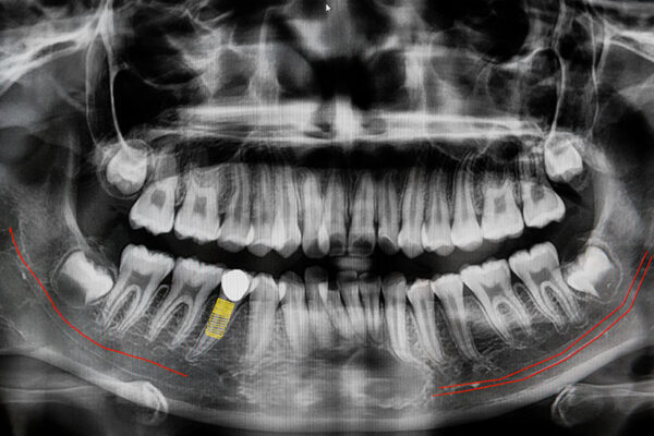 digital-x-ray-of-jaw-with-implant-tooth