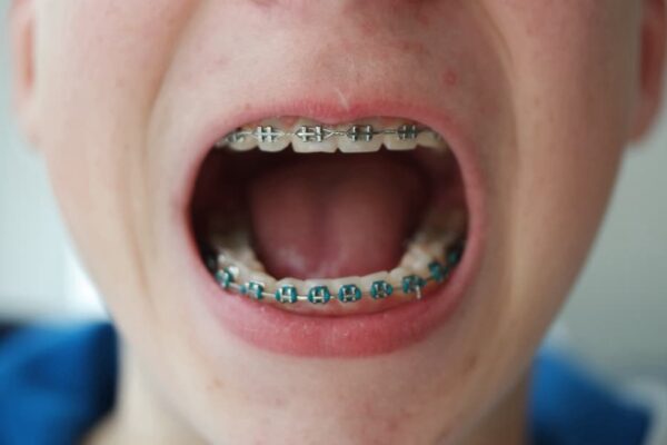 mouth-open-with-teeth-and-braces-teenage-skin-be-2021-08-30-10-16-45-utc (1)