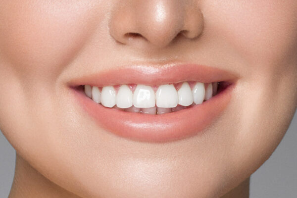 veneer20201030